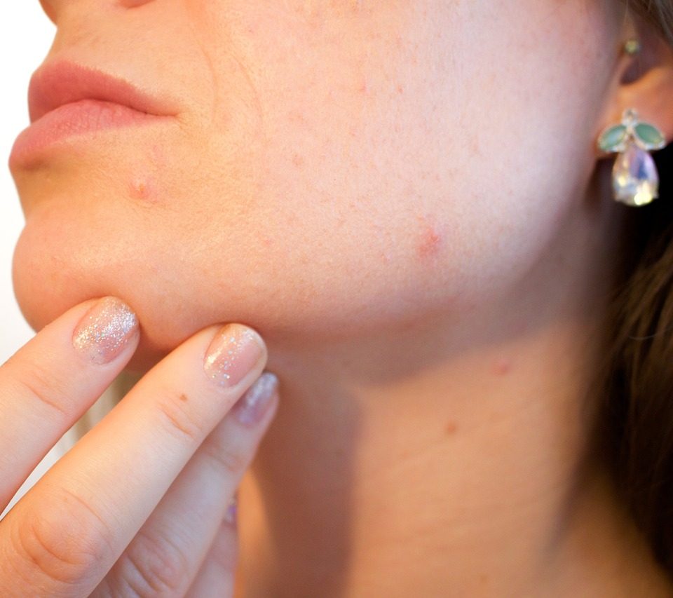 acne, pores, skin